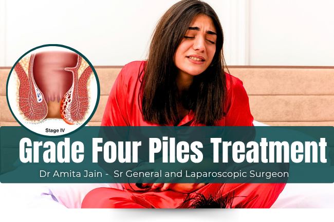 Grade Four Piles or Internal Hemorrhoids treatment by Dr Amita Jain